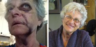 Marianne Clift immediately after the attack and a week later.