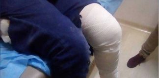 Dog attack victim in La Paz.