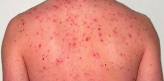 Twelve cases of measles have been identified.