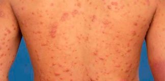 The disease hasn't been considered a health problem since 2018.