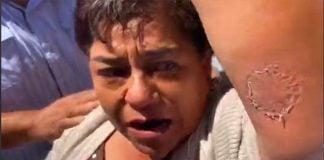 A lawmaker shows bite mark following a tiff in the legislature.