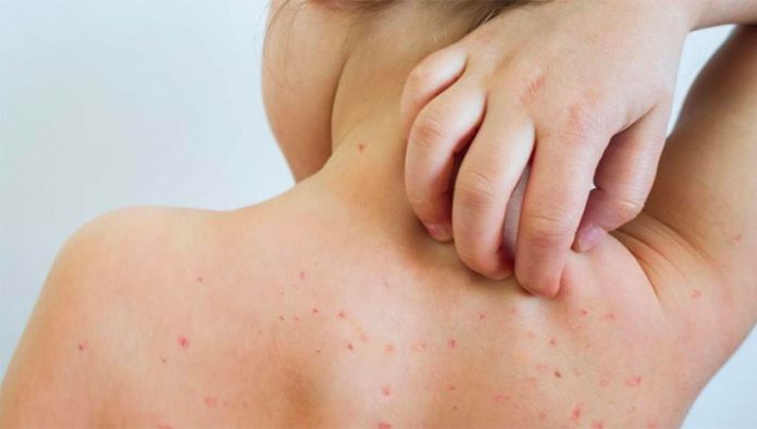 It's not coronavirus, but measles cases are spreading.