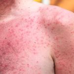 A victim of heat rash.