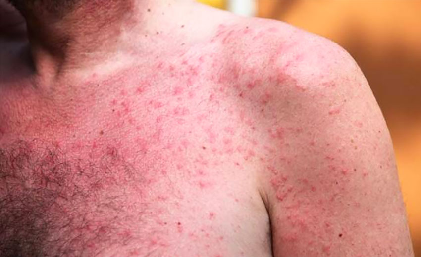 Can Heat Rash Occur All Over The Body