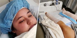 A crocodile attacked Kiana Hummel, 18, in Puerto Vallarta earlier this month.