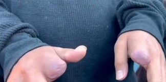 youth without index fingers