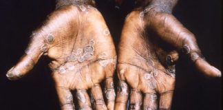 The formation of pustules on the skin is one of the characteristic symptoms of monkeypox.