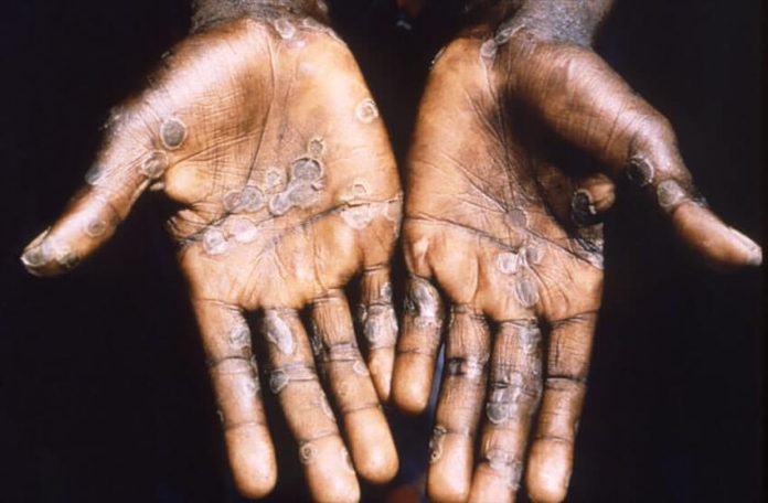 The formation of pustules on the skin is one of the characteristic symptoms of monkeypox.
