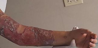 11-year old girl burned by mental health workers in Jalisco