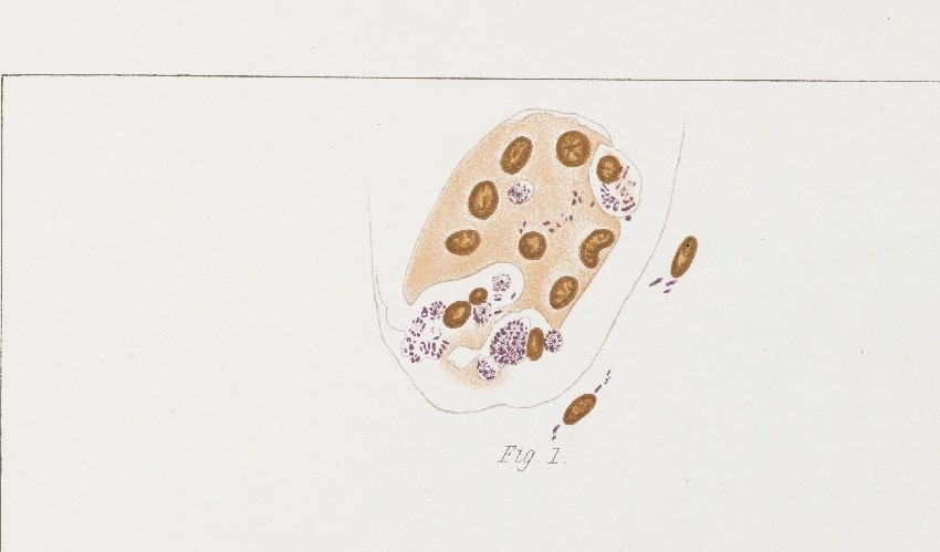 Ilustración de células infectadas con lepra.