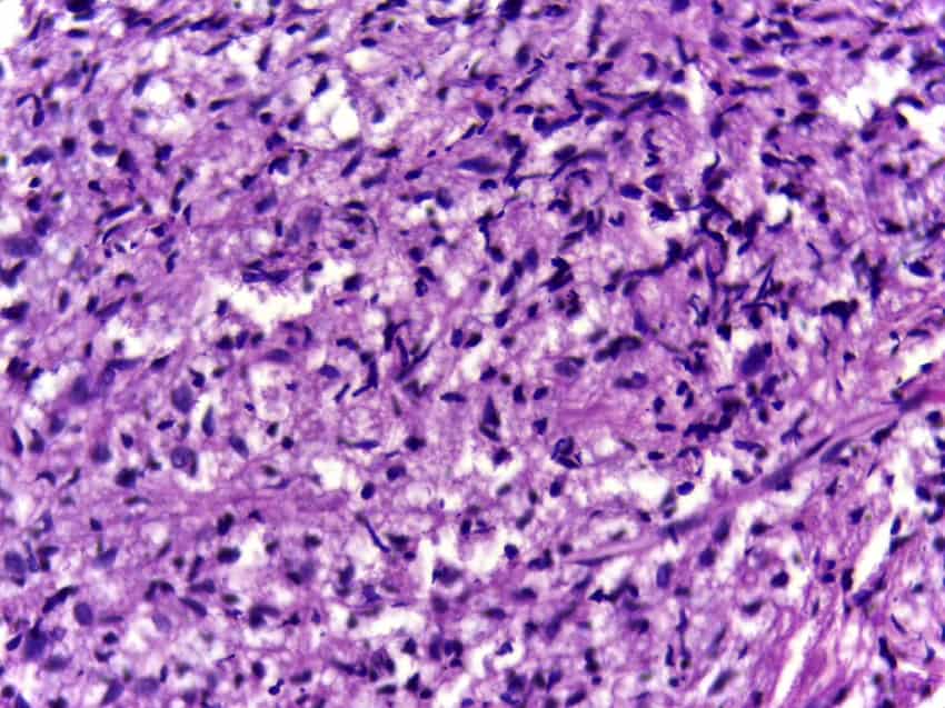 Cross section of lepromatous leprosy