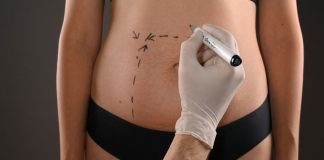A hand marks a woman's stomach for plastic surgery