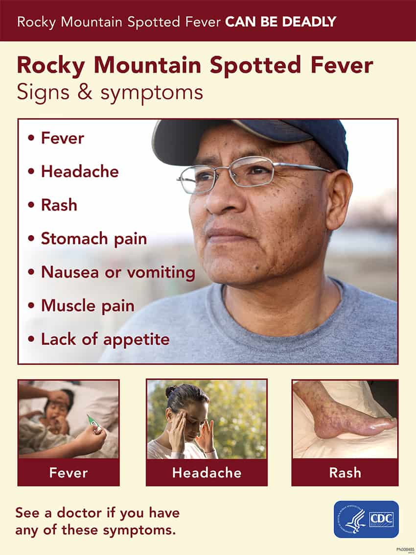 A CDC poster describes the signs and symptoms of RMSF