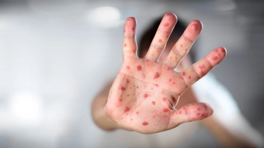 Measles Guadalajara