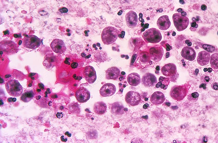 Naegleria fowleri,
